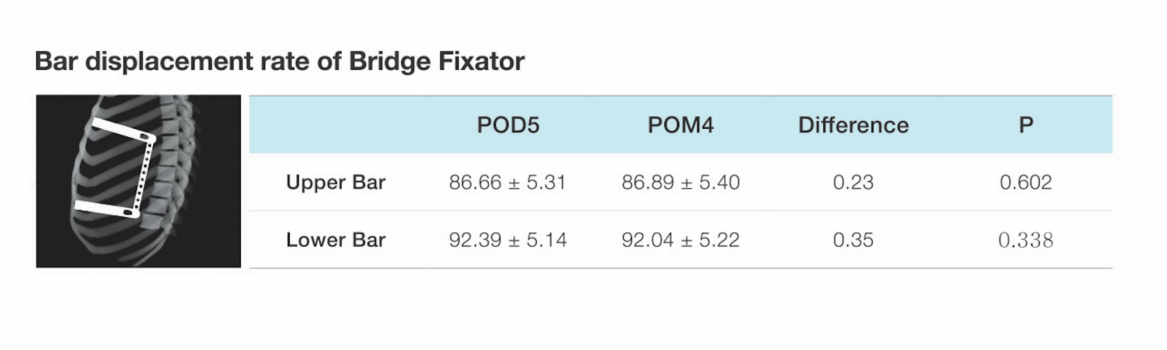 Bar displacement rate of Bridge Fixator, comparing POD5 and POM4 for the upper bar and lower bar