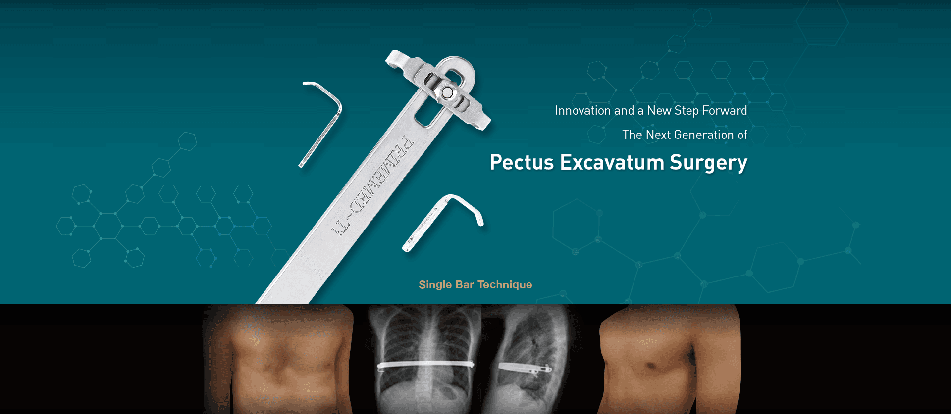 Easy Crane System: the next generation of pectus excavatum surgery