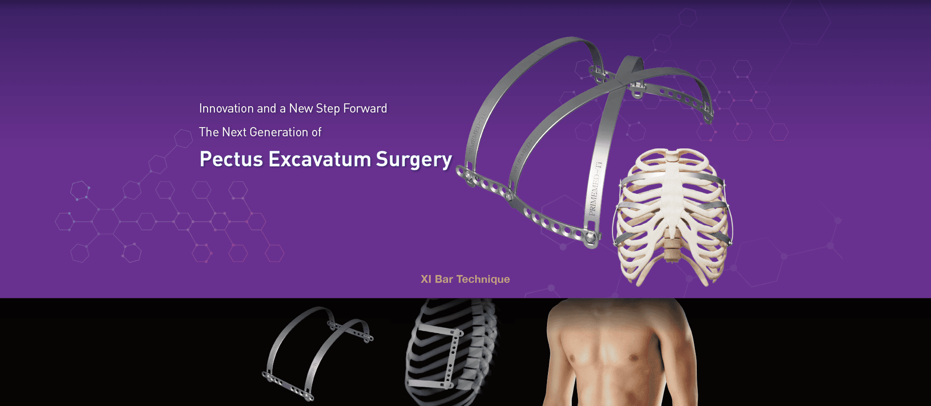 XI Bar Technique: the next generation of pectus excavatum surgery
