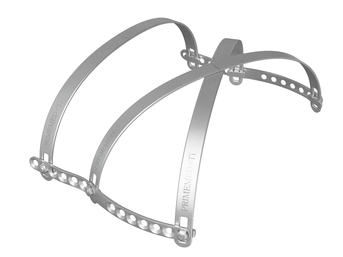 XI Bar Technique: the next generation of pectus excavatum surgery